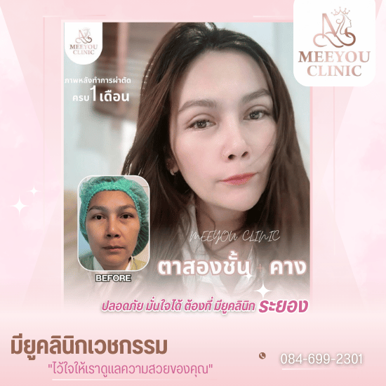คลินิกรักษาสิวระยอง