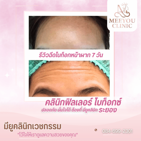 ฉีดฟิลเลอร์ โบท็อกซ์ ระยอง