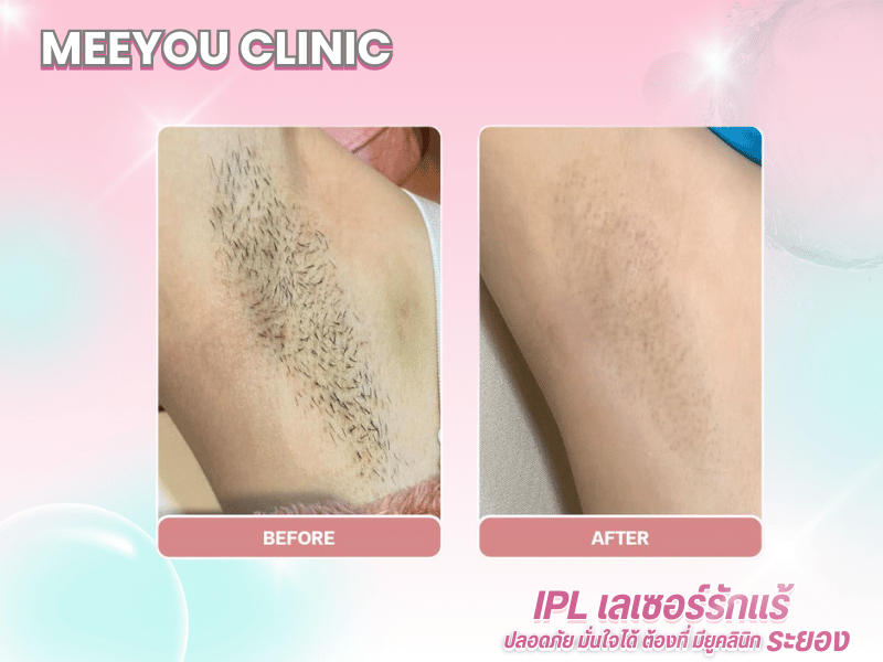 ปรับรูปหน้า ยกกระชับ เติมเต็มความอ่อนเยาว์ บริการ HIFU%2C โบท็อกซ์ และฟิลเลอร์ (3)